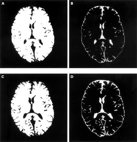 A longitudinal study of brain atrophy and cognitive disturbances in the early phase of relapsing ...