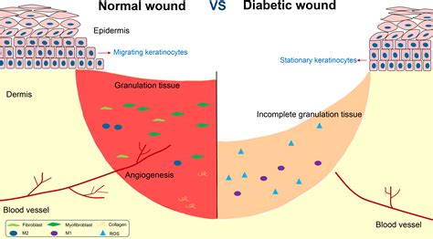 Wound Healing In Diabetic Patients