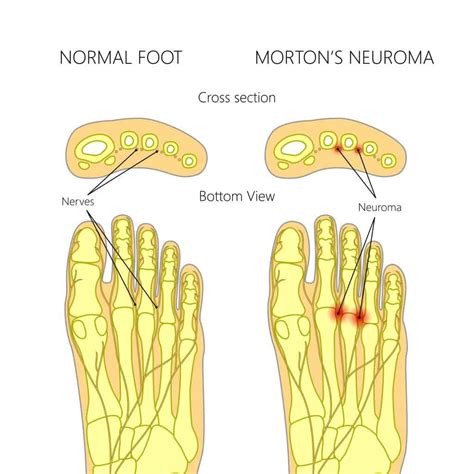 Morton's Neuroma Surgery
