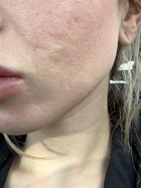 I have pitted acne scars and a aesthetician told me to do 6 sessions of Skin Pen but she barely ...