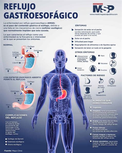 Reflujo gastroesofágico