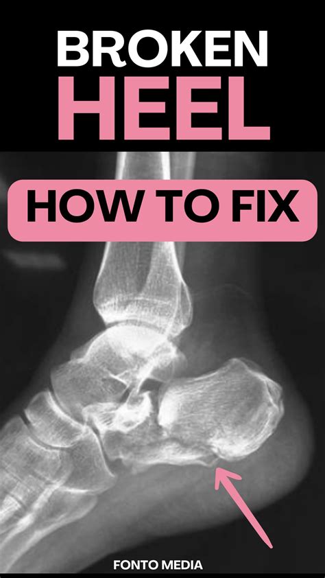 Walking on broken heel bone tips for good recovery – Artofit