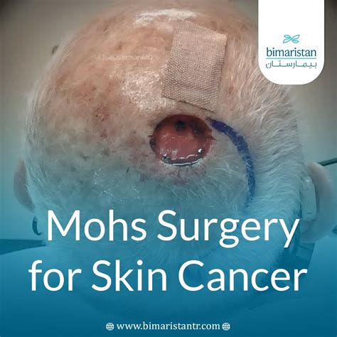 How Mohs Surgery for Skin Cancer Offers Precise and Effective Treatment - بيمارستان