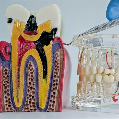 Does a Root Canal Hurt? Understanding the Truth - Healthhype