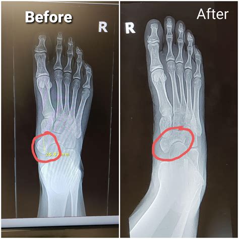 Navicular Syndrome Accessory Navicular Syndrome??? : R/FootFunction