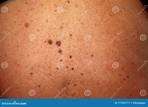 Skin Rash Skin Cancer Skin Wart Stock Image - Image of concern, cancer ...
