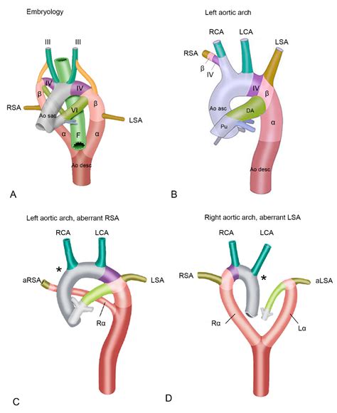 The Clinical Spectrum of Kommerell’s Diverticulum in Adults with a Right-Sided Aortic Arch: A ...