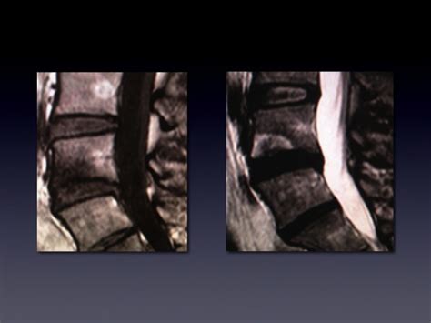 Image result for Disco Injection