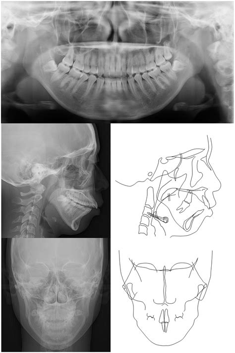 A case of anterior open bite associated with idiopathic condylar resorption treated with ...