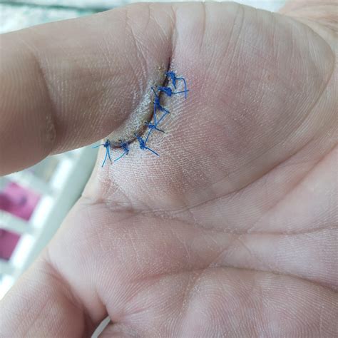 Trigger finger : r/carpaltunnel