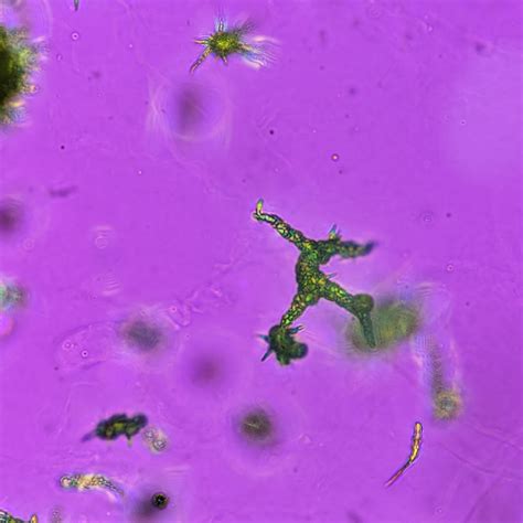 Ammonium Biurate Crystal Identification