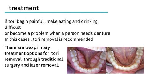 Tori palatinus , tori madibularis and treatment | PPTX