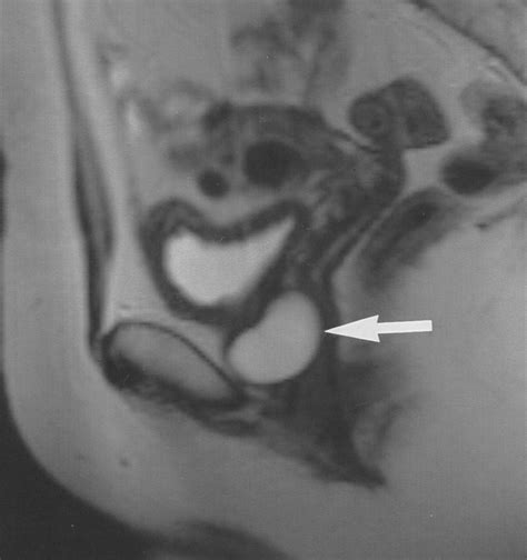 Urethral Diverticulum Mri