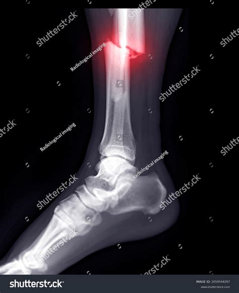 골절경골과 섬유뼈를 보여주는 발목 관절의 엑스레이 스톡 일러스트 2059544297 | Shutterstock