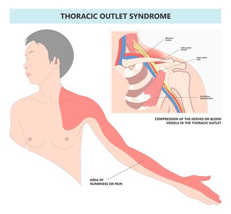 Thoracic outlet syndrome : evaluation and management simplified - Bia ...