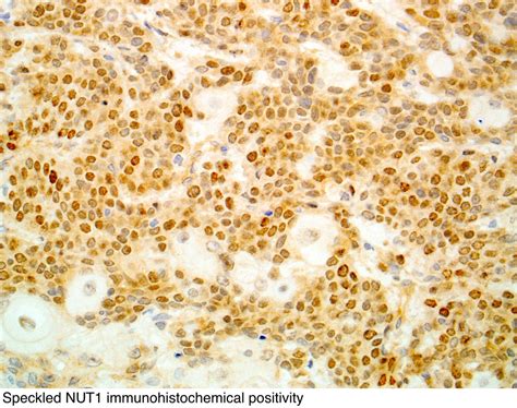 Nut Cell Cancer at Kaitlyn Fitzhardinge blog