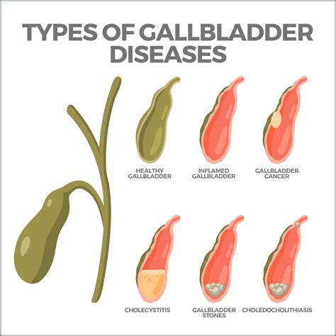 Gallbladder Problems 的图像结果