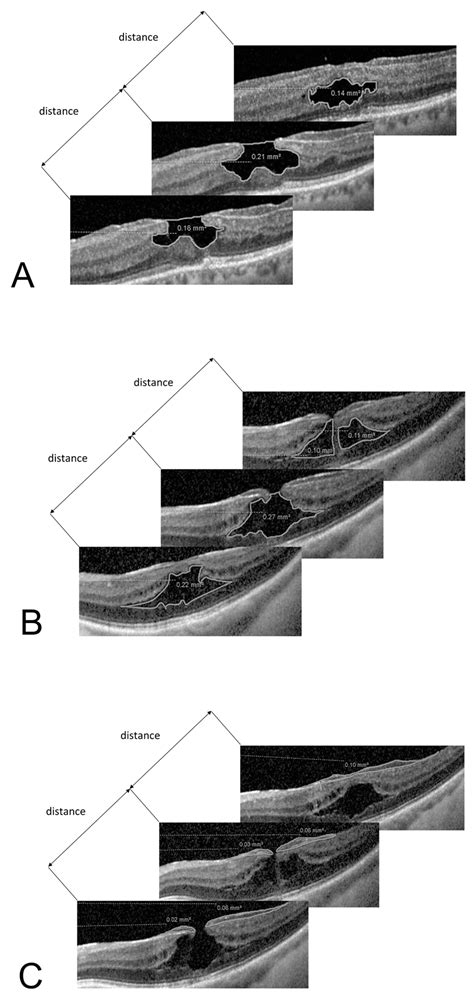 Volumetric Biomarkers of Visual Outcome after Surgical Repair in ...