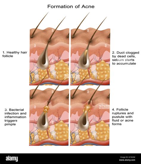 Collection 28+ Pictures keratosis pilaris clogged hair follicle pulled out Sharp