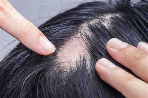 What is Alopecia and How to treat alopecia | Dr. Kushal Jain