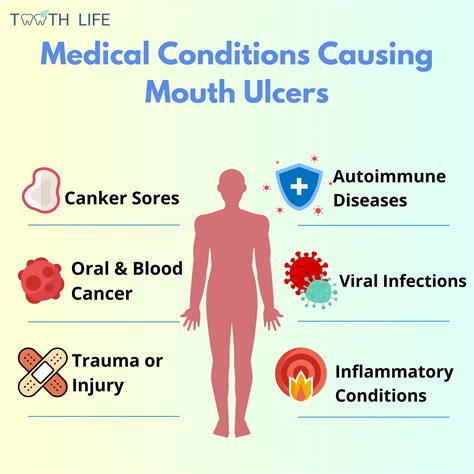 Canker Sores: A Closer Look at These Mysterious Ulcers