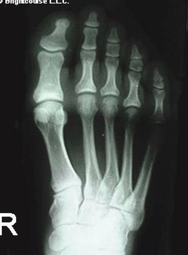 Image result for Front View of Toe