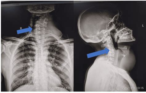 Airway management of huge thyroid swelling having tracheal deviation ...