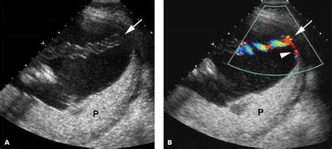 Bildergebnis für velamentous umbilical cord ultrasound