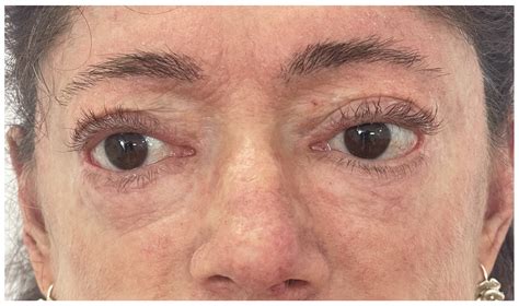 Pushing the Limits: Aesthetic Surgery Breakthrough in a High-Dose ...