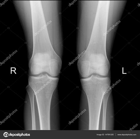 X ray of healthy knee joint | X-ray of knee joints in frontal ...