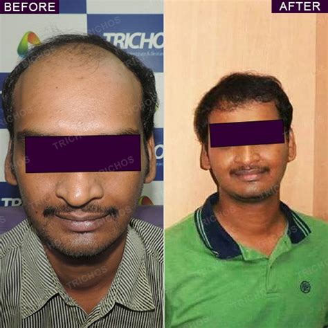 Trichos | Best Hair Treatment in Hyderabad | Dr John Watts