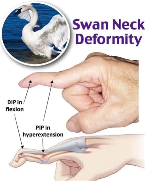Swan Neck Deformity - MEDizzy