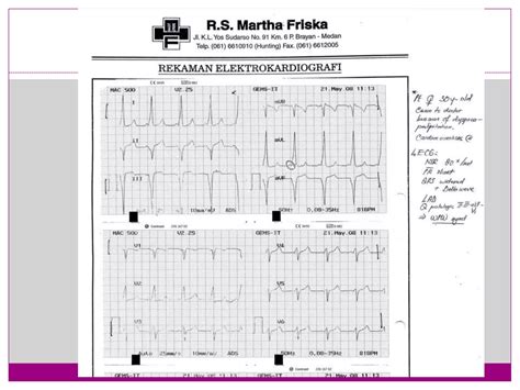 Basic of Pre-excitation syndrome | PPTX