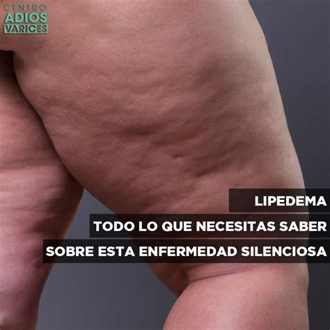LIPEDEMA 】 SÍNTOMAS Y TRATAMIENTO LIPEDEMA