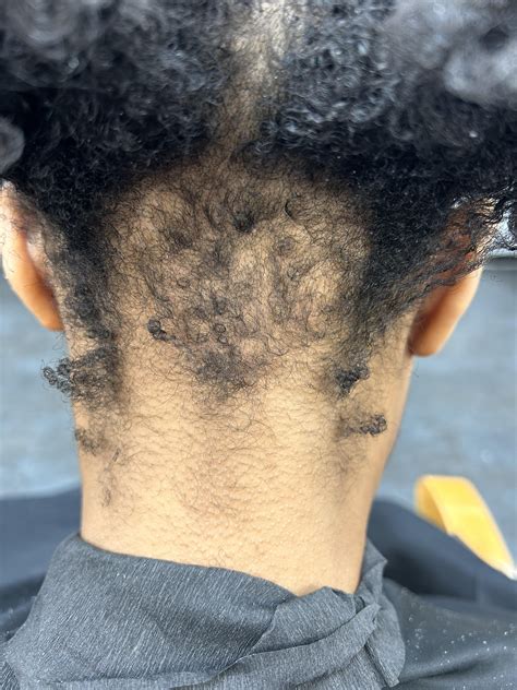 Breakage at nape of neck : r/Naturalhair