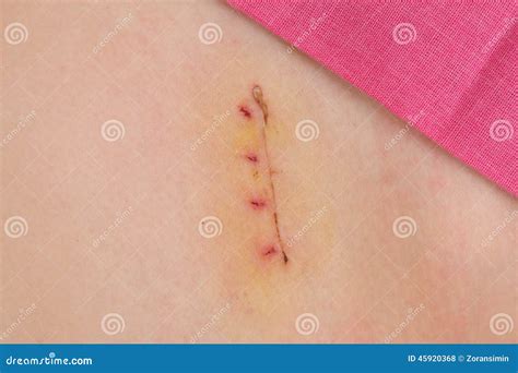 Image result for Appendix Surgery Scar