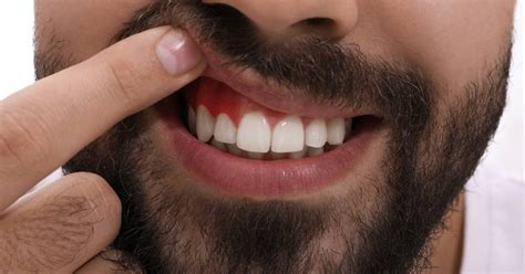 Does Gum Disease Go Away When Teeth Are Removed? [year] Guide