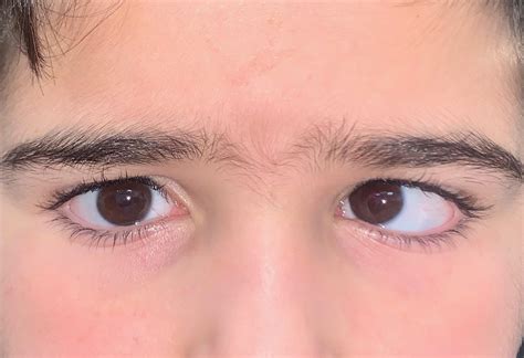 ¿Qué es el estrabismo y cómo se diagnostica? - Clietsa S.A.