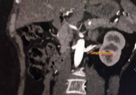 Image result for Hand-Assisted Nephrectomy