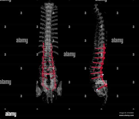 CT scan of thoracic and lumbar spine 3d rendering showing pedicle screw ...
