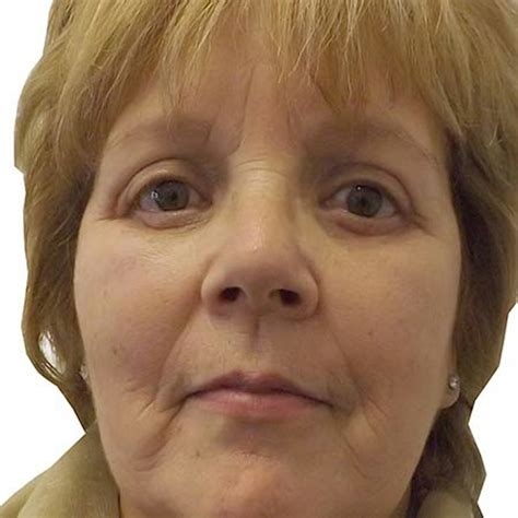 Blepharoplasty | Eye Bag Removal Surgery UK | MYA Cosmetic Surgery