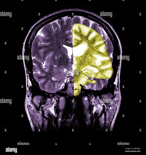 Normal coronal mri brain hi-res stock photography and images - Alamy