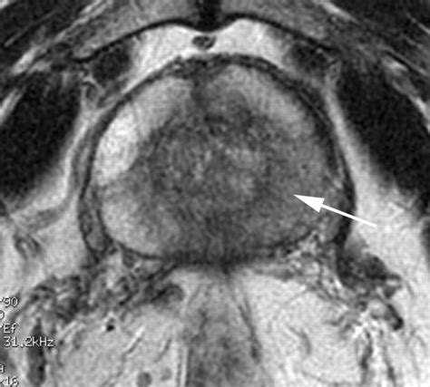 MRI of Prostate Cancer at 1.5 and 3.0 T: Comparison of Image Quality in ...