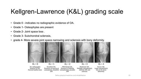 Kellgren And Lawrence Grading