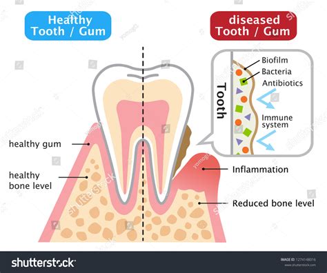 672 Biofilm Infection Images, Stock Photos & Vectors | Shutterstock