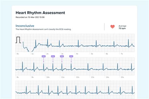 What Ectopic Atrial Rhythm Looks Like on Your Watch ECG | Qaly
