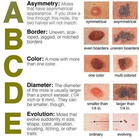 Abcde Rule For Skin Cancer