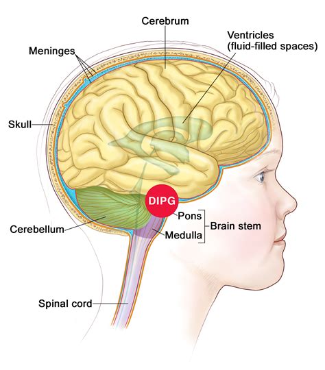 What Is DIPG? — Levi's Project