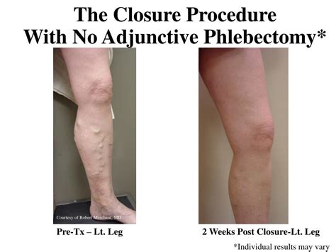 Image result for Closure Procedure