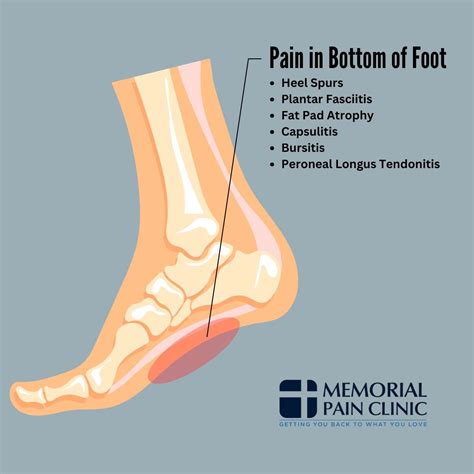 Foot Pain Chart: Common Foot Problems | Memorial Pain Clinic